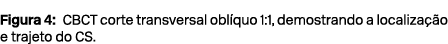 Figura 4: CBCT corte transversal obl quo 1:1, demostrando a localiza o e trajeto do CS.