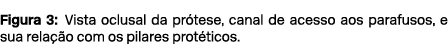 Figura 3: Vista oclusal da pr tese, canal de acesso aos parafusos, e sua rela o com os pilares prot ticos.