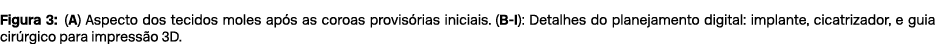 Figura 3: (A) Aspecto dos tecidos moles ap s as coroas provis rias iniciais. (B I): Detalhes do planejamento digital:...