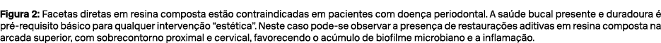 Figura 2: Facetas diretas em resina composta est o contraindicadas em pacientes com doen a periodontal. A sa de bucal...