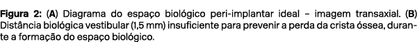 Figura 2: (A) Diagrama do espa o biol gico peri implantar ideal – imagem transaxial. (B) Dist ncia biol gica vestibul...