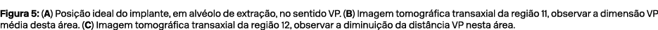 Figura 5: (A) Posi o ideal do implante, em alv olo de extra  o, no sentido VP. (B) Imagem tomogr fica transaxial da ...