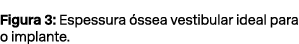 Figura 3: Espessura ssea vestibular ideal para o implante.