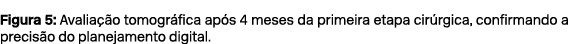Figura 5: Avalia o tomogr fica ap s 4 meses da primeira etapa cir rgica, confirmando a precis o do planejamento digi...
