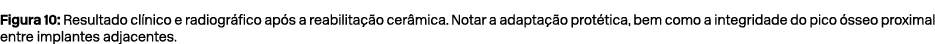 Figura 10: Resultado cl nico e radiogr fico ap s a reabilita o cer mica. Notar a adapta  o prot tica, bem como a int...