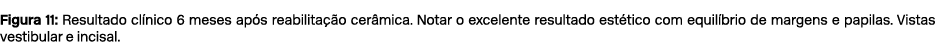 Figura 11: Resultado cl nico 6 meses ap s reabilita o cer mica. Notar o excelente resultado est tico com equil brio ...